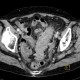 Diverticulitis, acute diverticulitis, peritonitis: CT - Computed tomography
